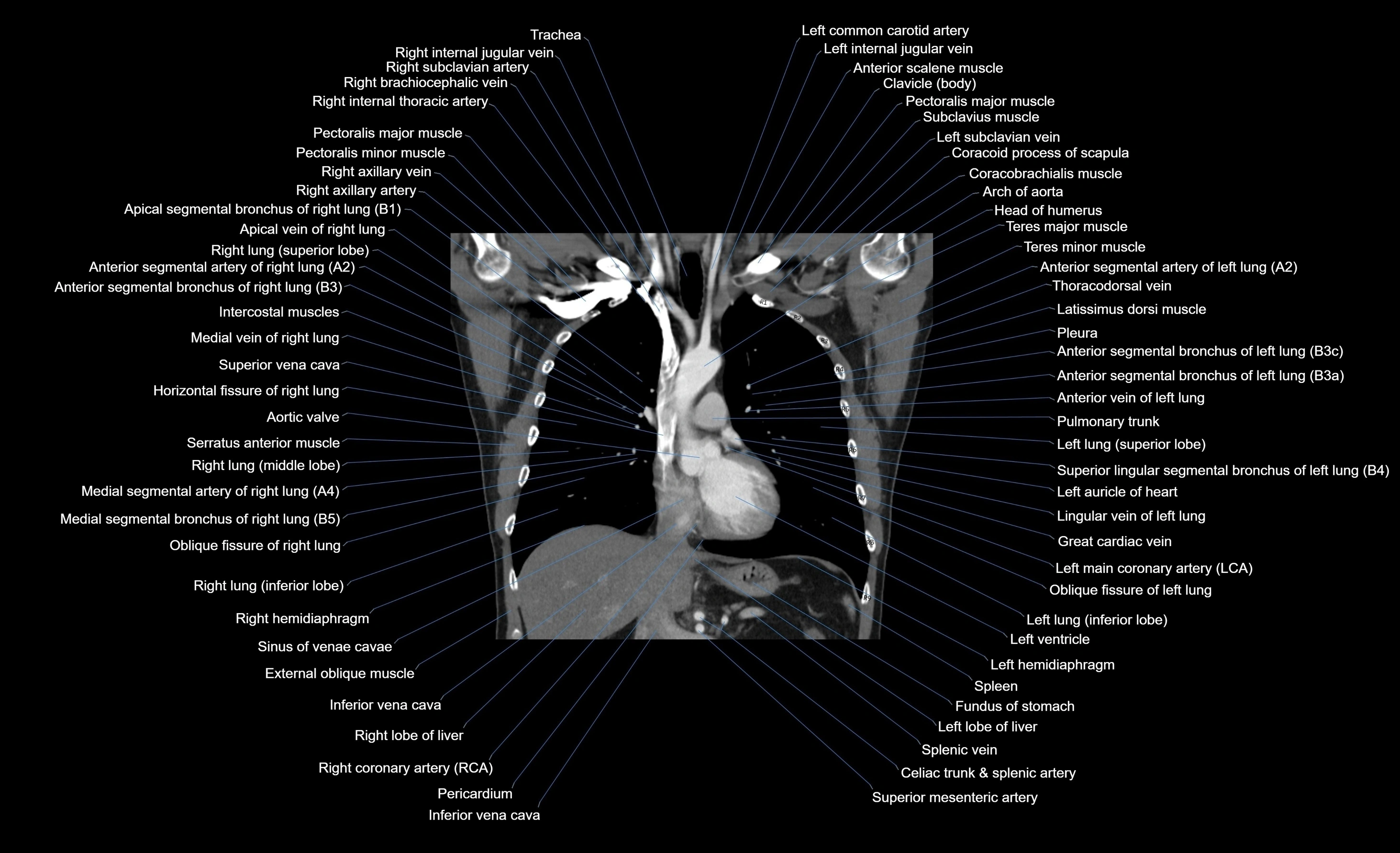 CT chest (thorax) soft tissue window labelled coronal cross sectional anatomy radiology image-00067.webp